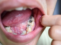 NHS nadal stosuje plomby amalgamatowe. Polacy w UK oburzeni