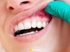 Masz krwawiące dziąsła? Uważaj, to mogą być problemy z sercem