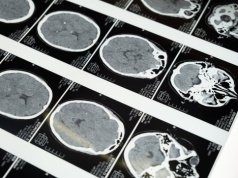 Jak rozwija się choroba Alzheimera? Naukowcy odkryli drogę rozprzestrzeniania się białka tau