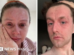 'Nasza skóra odpada i nikt nie potrafi nam powiedzieć, dlaczego'