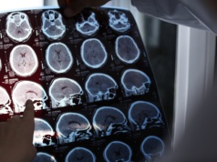 Po 40-tce zadbaj o prawidłowy poziom witaminy D. Zmniejsza ryzyko alzheimera