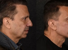 "Przynoszą zdjęcia z czterdziestki". Menedżerowie w USA lgną do chirurgów plastycznych