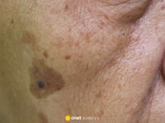 Ten krem na noc to likwidator plamek starczych! Usuwa przebarwienia w mig