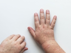 Genom sprzed wieków ujawnia tajemnicę szkarlatyny. Zaskakujące odkrycie