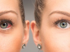 Nużeniec – czym jest, jakie daje objawy, jak go leczyć?