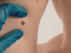 Czerniak długo nie daje objawów, dlatego łatwo go przegapić