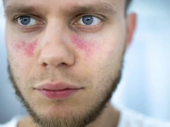 Pierwsza od 70 lat realna szansa na skuteczne leczenie skórnej postaci tocznia rumieniowatego