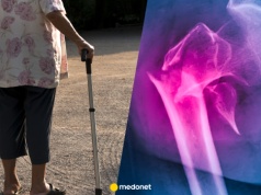 Cicha epidemia osteopenii. Oto dlaczego twoje kości są coraz słabsze