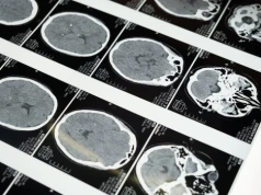 Immunoterapia doprowadziła do całkowitej remisji agresywnego raka przysadki mózgowej