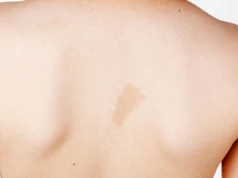 "Córka mogła obudzić się z porażeniem czterokończynowym". Pacjenci o życiu z neurofibromatozą