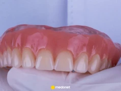 Proteza zaczyna wypadać i psuje uśmiech. Dentystka radzi, co można zrobić "na już"