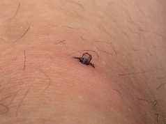 Kleszcze atakują. Coraz więcej zgłoszeń w województwie łódzkim