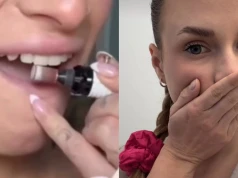 Piłują zęby frezarką. "Dentysta robi to samo, ale drożej"? Higienistka: Może dojść do obumarcia