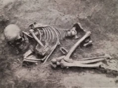 Ślady trepanacji czaszki u dziecka sprzed ok. 4 tys. lat