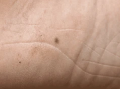 Ten nowotwór najłatwiej zauważyć, gdy rosną temperatury. Zwróć uwagę na te miejsca