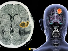 Neurochirurg: glejak wciąż jest jednym z najtrudniejszych nowotworów do leczenia