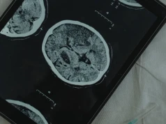 Dr hab. Karol Wiśniewski: "Glejak pozostaje jednym z najtrudniejszych nowotworów mózgu"