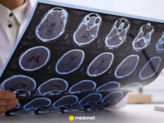 Nowe badanie zmienia podejście do SM. Ta terapia dorównuje droższym lekom