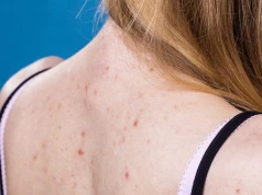 Wypryski na plecach latem do zmora. Dermatolog radzi, jak się ich pozbyć