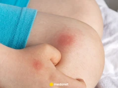 Babciny sposób na ukąszenia. Polecają go nawet lekarze