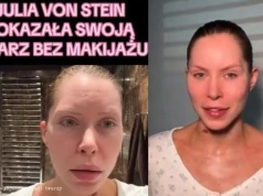 Julia von Stein ostrzega przed operacjami plastycznymi. Twierdzi, że teraz nie może się uśmiechać i musi przejść kolejną operację