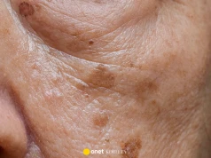 Przebarwienia po opalaniu? Ten krem ściera je jak peeling kwasowy u kosmetyczki