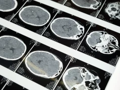Nowa technologia mapuje glejaka w 3D. Analiza trwa około 30 minut