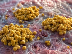 Eradykacja MRSA w mukowiscydozie: aktualizacja Cochrane nie potwierdza skuteczności rutynowego leczenia