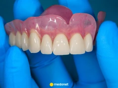 Jaka jest najlepsza proteza zębowa? Dentystka tłumaczy, jakie są opcje
