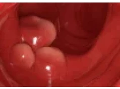 Modyfikowane gen. probiotyki eliminują 43% nowotworów jelita grubego u myszy..