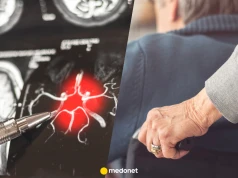 Nowe leki na chorobę Alzheimera zmieniają zasady gry. Czechy mają oczekujących pacjentów